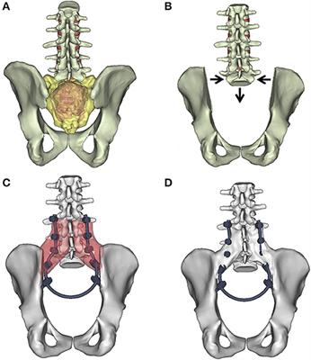 A Novel Three-Dimensional Computational Method to Assess Rod Contour Deformation and to Map Bony Fusion in a Lumbopelvic Reconstruction After En-Bloc Sacrectomy